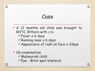 Case
• A 12 months old child was brought to
RHTC, Rithora with c/o
Fever x 6 days
Running nose x 6 days
Appearance of rash on face x 2days
• On examination
Malnourish child
Eye - Bitot spot bilateral
 