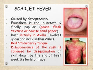 Measles Rash Dsitribution Maculopapular Rash Measles