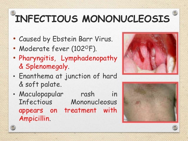 Measles
