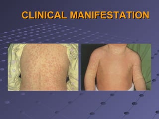 Messles Rash Distribution Measles | PPT