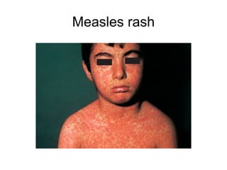 Measles | PPT