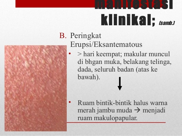 Measles Measles
