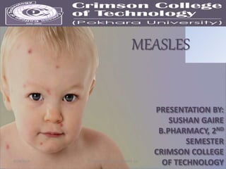 1
MEASLES
PRESENTATION BY:
SUSHAN GAIRE
B.PHARMACY, 2ND
SEMESTER
CRIMSON COLLEGE
OF TECHNOLOGY8/28/2018 PHARMACEUTICAL SEMINAR 1st
 