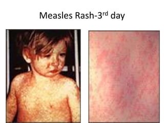 Measles Rash Element Measles | PPTX