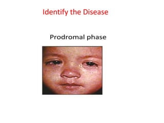 Identify the Disease
 