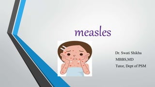 measles
Dr. Swati Shikha
MBBS,MD
Tutor, Dept of PSM
 