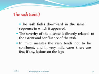 Messles Rash Distribution Measles | PPTX