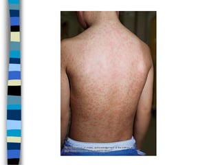 Measles.ppt