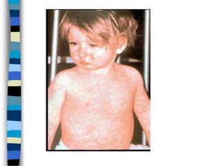 Measles.ppt