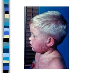 Measles.ppt