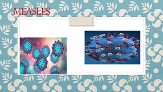 MEASLES
 