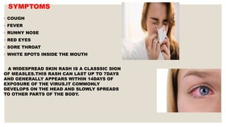 SYMPTOMS
◦ COUGH
◦ FEVER
◦ RUNNY NOSE
◦ RED EYES
◦ SORE THROAT
◦ WHITE SPOTS INSIDE THE MOUTH
A WIDESPREAD SKIN RASH IS A CLASSSIC SIGN
OF MEASLES.THIS RASH CAN LAST UP TO 7DAYS
AND GENERALLY APPEARS WITHIN 14DAYS OF
EXPOSURE OF THE VIRUS.IT COMMONLY
DEVELOPS ON THE HEAD AND SLOWLY SPREADS
TO OTHER PARTS OF THE BODY.
 