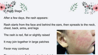 Stage 1 Rash Measles. their stages and treatment.pptx