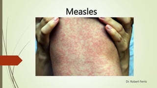 Measles
Dr. Robert Ferris
 