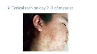  Typical rash on day 2–3 of measles
 