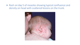  Rash on day 5 of measles showing typical confluence and
density on head with scattered lesions on the trunk.
 