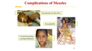 Encephalitis
Complications of Measles
Pneumonia & diarrhea
Corneal scarring
causing blindness
19
 