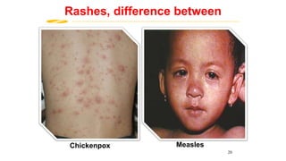 MeaslesChickenpox
Rashes, difference between
20
 