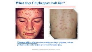 What does Chickenpox look like?
PROGRAMME FOR IMMUNIZATION PREVENTABLE DISEASES
Pleomorphic rashes (rashes on different stage): papules, vesicles,
pustules and scab formation are seen at the same time.
 