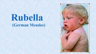 Rubella
(German Measles)
 