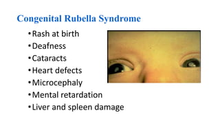 Congenital Rubella Syndrome
•Rash at birth
•Deafness
•Cataracts
•Heart defects
•Microcephaly
•Mental retardation
•Liver and spleen damage
 