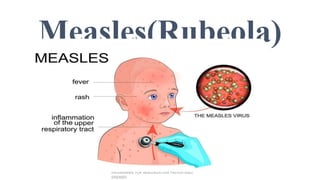 Understanding measles and rubella . ppt | PPT