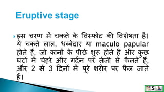 Measles in hindi. ,measles | PPTX