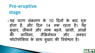 Measles in hindi. ,measles | PPTX