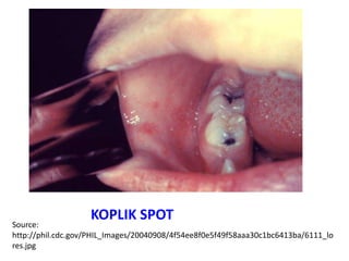 KOPLIK SPOT
Source:
http://phil.cdc.gov/PHIL_Images/20040908/4f54ee8f0e5f49f58aaa30c1bc6413ba/6111_lo
res.jpg
 