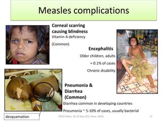 SEPIO Meet, 18-20 May 2011 Bose, WHO 15
Measles complications
Corneal scarring
causing blindness
Vitamin A deficiency
(Common)
Encephalitis
Older children, adults
≈ 0.1% of cases
Chronic disability
Pneumonia &
Diarrhea
(Common)
Diarrhea common in developing countries
Pneumonia ~ 5-10% of cases, usually bacterial
desquamation
 