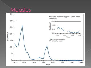 Measles