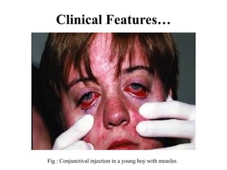 Clinical Features…
Fig : Conjunctival injection in a young boy with measles
 