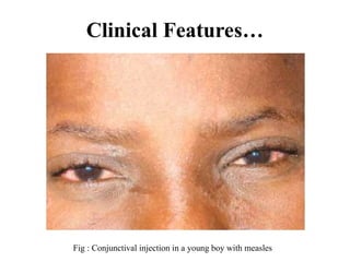 Clinical Features…
Fig : Conjunctival injection in a young boy with measles
 