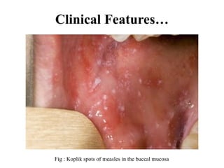 Clinical Features…
Fig : Koplik spots of measles in the buccal mucosa
 