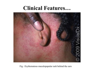 Clinical Features…
Fig : Erythematous maculopapular rash behind the ears
 