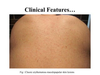 Clinical Features…
Fig : Classic erythematous maculopapular skin lesions
 