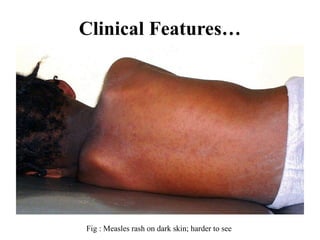 Clinical Features…
Fig : Measles rash on dark skin; harder to see
 