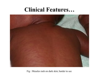 Clinical Features…
Fig : Measles rash on dark skin; harder to see
 