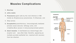 Measles Complications
1. Diarrhea
2. otitis media
3. Pneumonia:(giant cell) by the viral infection or SBI
mostly by Streptococcus pneumoniae, H.influenzae, and
4. Stap aureus.
5. Encephalitis:postinfectious, immunologically mediated
process cause seizures, lethargy coma, and
irritability.More severe in immunocompromised patient.
6. black measles. It manifested as a hemorrhagic skin
eruption and was often fatal. Keratitis, appearing as
multiple punctate epithelial foci, resolved with recovery
from the infection
 