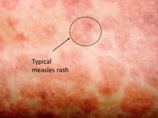 Measles and rubella | PPT