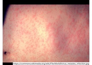 https://commons.wikimedia.org/wiki/File:Morbillivirus_measles_infection.jpg
 