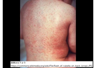 画像は以下より
https://commons.wikimedia.org/wiki/File:Rash_of_rubella_on_back_(crop).JPG
 