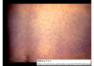 画像は以下より
https://commons.wikimedia.org/wiki/File:Rubella.jpg
 