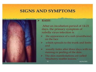 fever with rash in pediatric age groups | PPTX