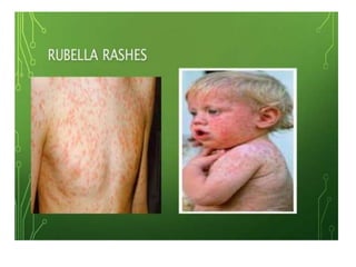 Generalized Rash Fever fever with rash in pediatric age groups | PPTX