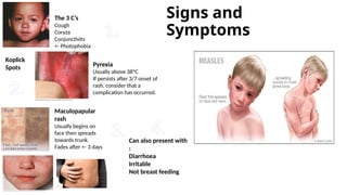 Pyrexia With Rash Measles presentation on infectious diseases in paediatric patients | PPTX