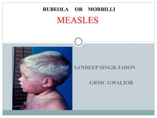 RUBEOLA OR MORBILLI
SANDEEP SINGH JADON
GRMC GWALIOR
MEASLES
 