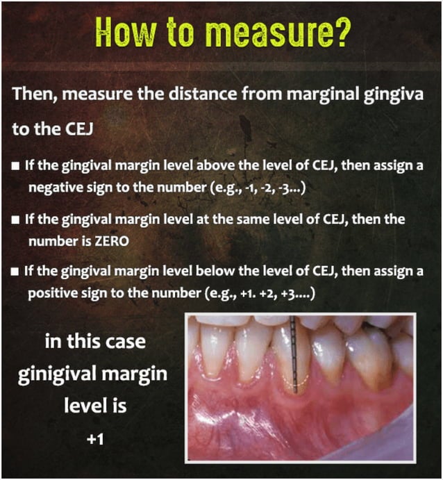 Measurement of Periodontal Attachment Loss PDF