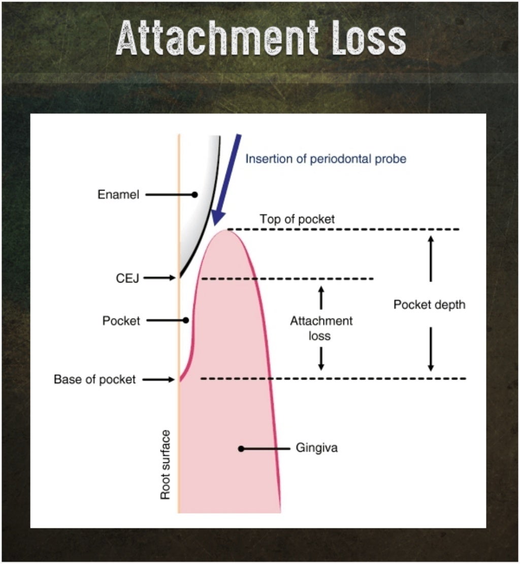 Measurement of Periodontal Attachment Loss