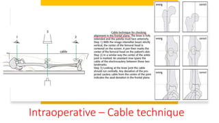 Intraoperative – Cable technique
 